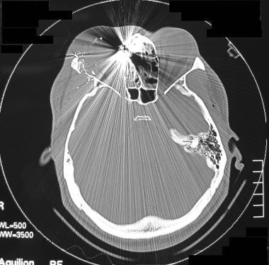 Computed tomography scan in a patient with a gunsh