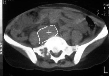 von Hippel-Lindau syndrome. Axial CT scan through 