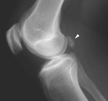 Lateral radiograph of the knee shows a calcified b