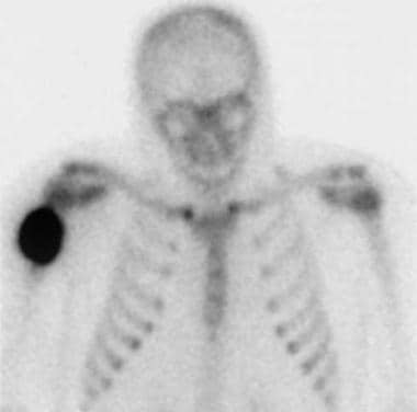 Delayed image from a technetium-99m (99mTc) methyl