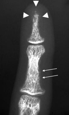 Anteroposterior radiograph of the finger in a pati