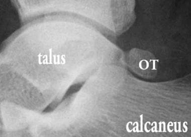 Os trigonum (OT), lateral radiograph. The ossicle 