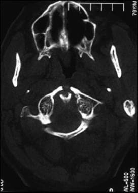 Axial unenhanced CT image through the C1 arch show