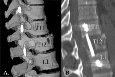 Lumbar spine trauma. Sagittal 3-dimensional and mu