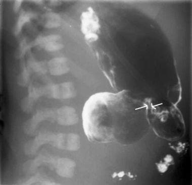 Barium air contrast–enhanced study of the duodenal