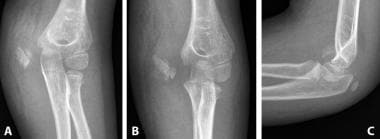 Medial condyle fracture with markedly rotated dist