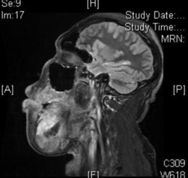 Sagittal fat-suppressed T1 postcontrast MRI of ven