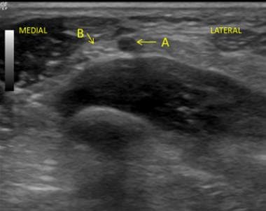 Ultrasound guided View of the Transverse process. 