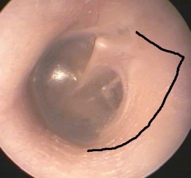 Outline of canal skin incisions to create tympanom