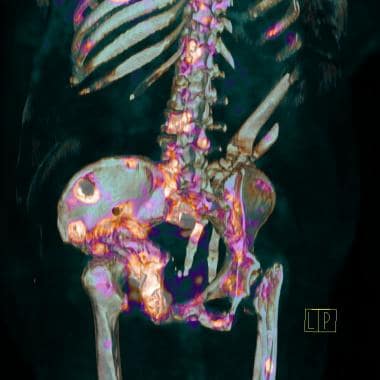 18-F NaF PET/CT image of metastatic bony disease i