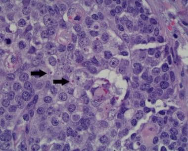 Trichilemmal carcinoma cells have large, lightly s