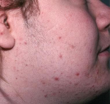 mild hirsutism in women