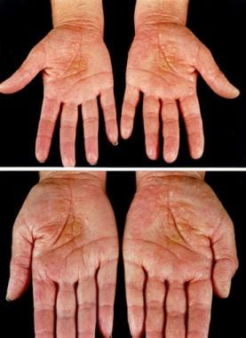 atopic dermatitis palms