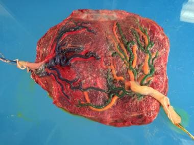 A monochorionic placenta with the vasculature of t