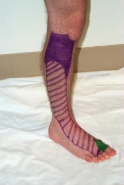 Peroneal sensory distribution: The striped area is