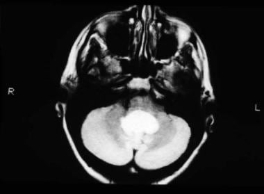 MRI, T2-weighted image, axial view, showing mixed 