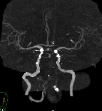 Spiral CT angiography showing occluded basilar art