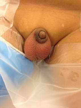 Example of scrotal appearance in testicular torsio