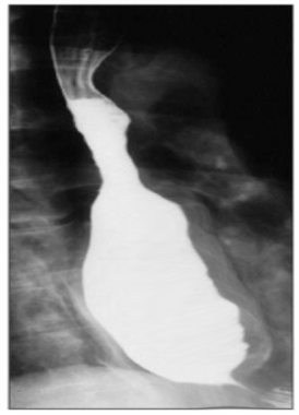 Radiograph of barium swallow in patient with long-