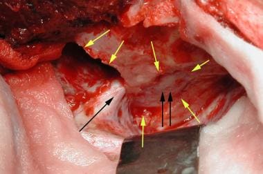 Intraoperative photo of same patient as in Media f