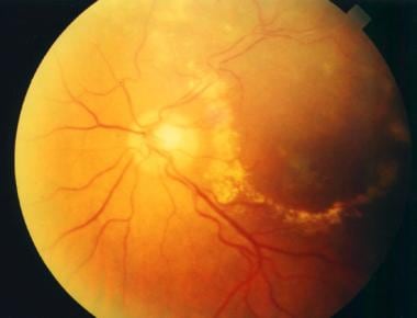 Patient with an old branch retinal vein occlusion 