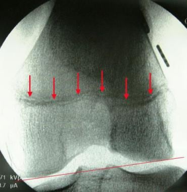 A fluoroscopic close-up view of the left knee demo
