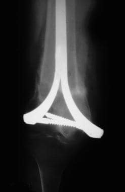 Supracondylar femur fracture treated with Zickel f