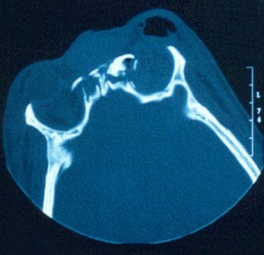 Lower cut of CT scan in a patient with fracture of