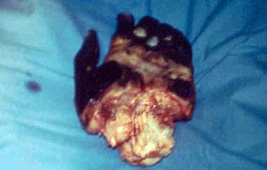 Amputation of a hand because of tissue necrosis. 
