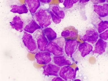 acute promyelocytic leukemia microgranular variant