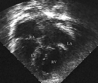 Apical image revealing atrioventricular discordanc