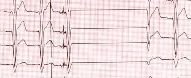 Pacemaker Malfunction. This image shows an artifac