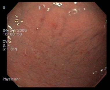 Erosive Gastritis Icd 10