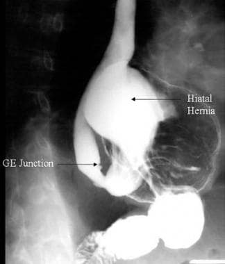 Hiatal Hernia. This image is a barium radiograph v