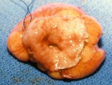 Duodenal lipoma resected through a duodenotomy. Ov