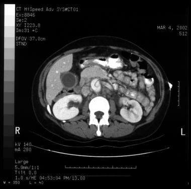 Aortic dissection. CT scan showing a flap (center 