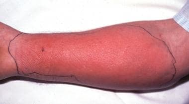 Erythema secondary to group A streptococcal cellul