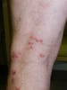 Varicella-Zoster Virus (VZV)