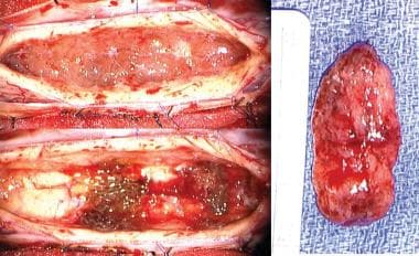 View of a cervical intramedullary ependymoma in si