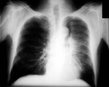 Atelectasis. Left upper lobe collapse. The Luft Si