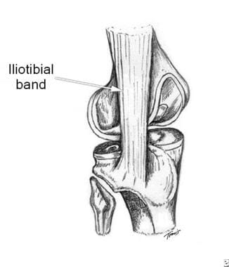 Iliotibial Band Friction Syndrome: Practice Essentials, Anatomy,  Pathophysiology