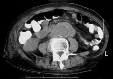 CT scan of the abdomen showing the typical paraaor