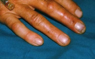 Grade 1 hydrofluoric (HF) acid burns of the finger