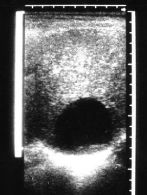 Ultrasonographic appearance of echinococcal cysts 