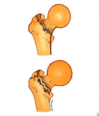 Intertrochanteric fractures. Top diagram is a sing