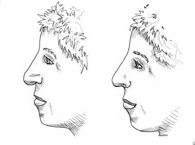 Rhinoplasty, tip ptosis. Nasal tip ptosis is a pro
