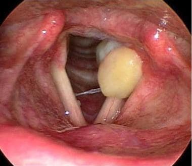 Left vocal process granuloma on initial presentati