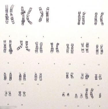 G-banded 47,XXY karyotype. 