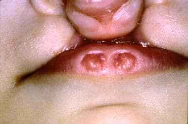 Closer view of cleft lip and cleft palate in an in