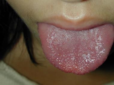 川崎病：草莓舌头。